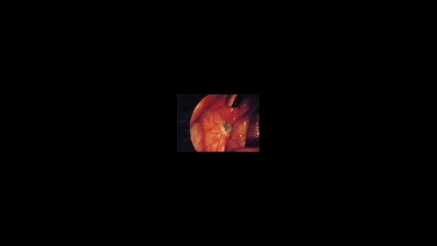 Endometrióza - obrázek