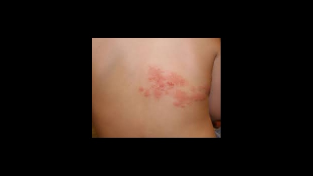 Faktory a průvodní choroby spojené s vyšší incidencí herpes zoster - obrázek