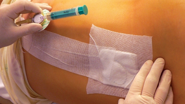 Epidurální analgezie - obrázek