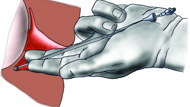 Paracervikální analgezie - obrázek