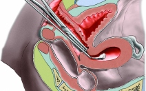 Potrat - abortus - obrázek