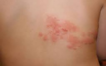 Faktory a průvodní choroby spojené s vyšší incidencí herpes zoster - obrázek