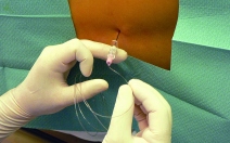 Epidurální analgezie - obrázek